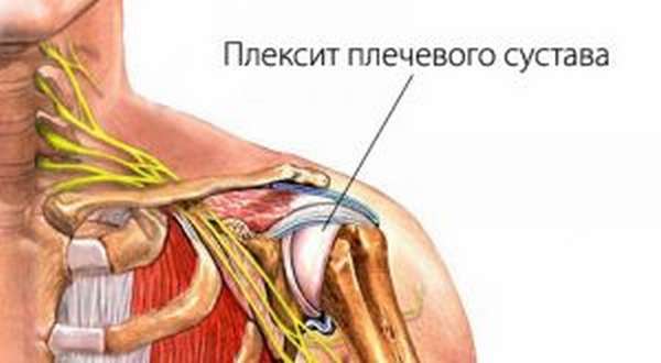 ЛФК при артрите плечевого сустава